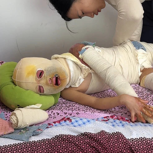 Urgent! Helping Children With Deep Burns