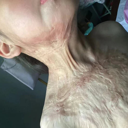 Urgent! Helping Children With Deep Burns