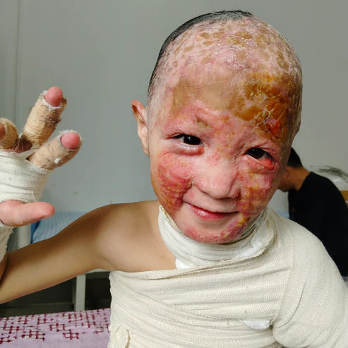 Urgent! Helping Children With Deep Burns